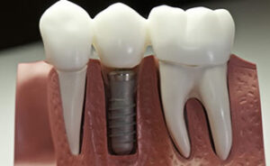 Is There an Age Limit for Dental Implants in Southern California?