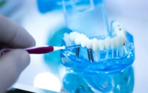 How to Clean Dental Implants