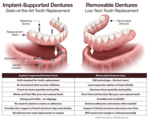 The Process of Getting Implant Dentures: What to Expect